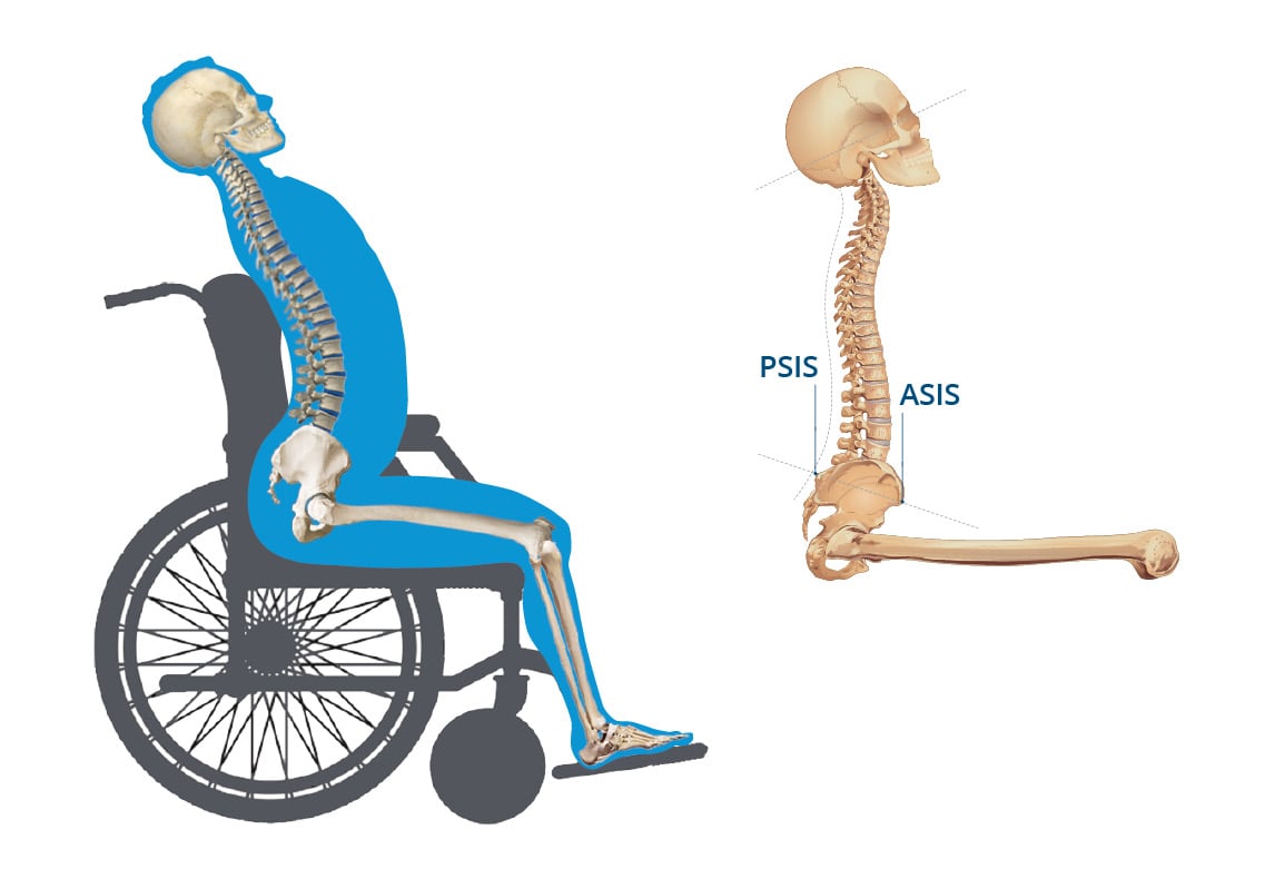 Anterior Pelvic Tilt Causes and Solutions through Wheelchair Positioning